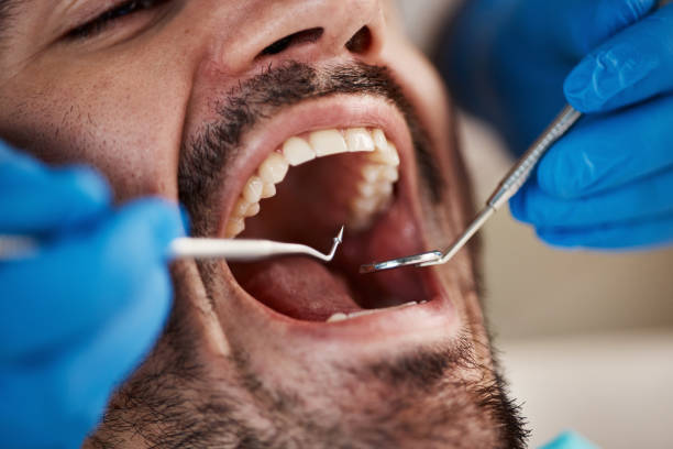 Best Emergency Tooth Extraction in Bellevue, MI